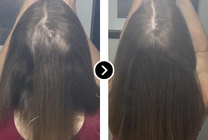 Before and After Facial Hair Growth - Patchy Beard Filling