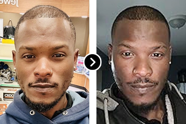 Before and After Hair Regrowth Result - Male Crown Pattern