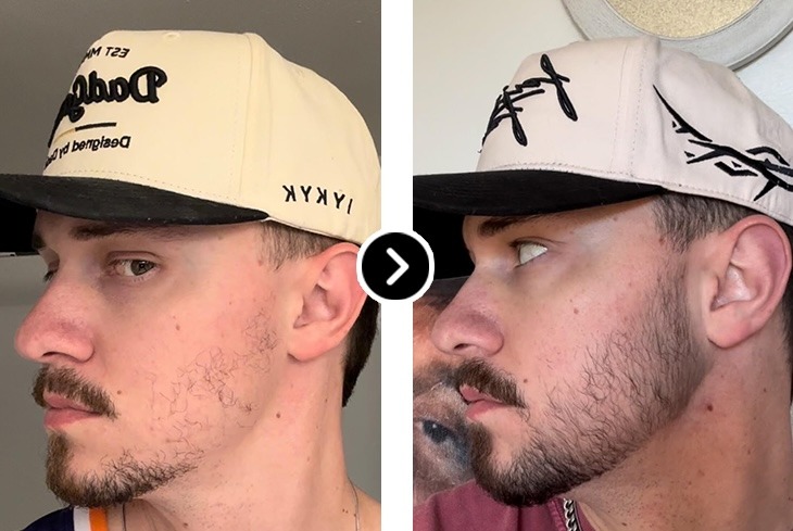 Before and After Hair Restoration - Male Receding Hairline