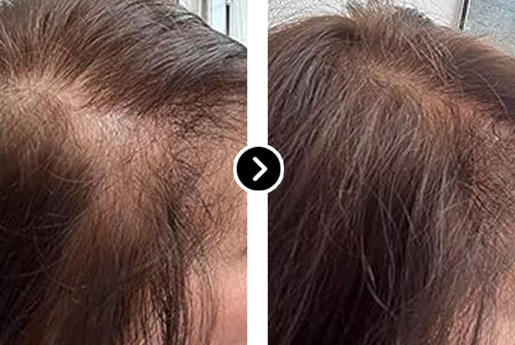 Before and After Hair Volume Restoration - Female Part Line